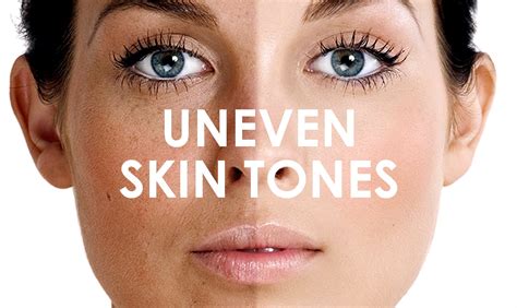 uneven skin tone   face body premier clinic