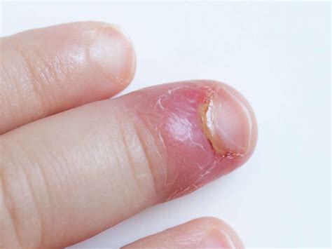paronychia   treatment   infected nail