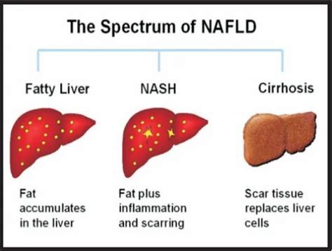 speciality clinic non alcohol fatty liver disease nafld service