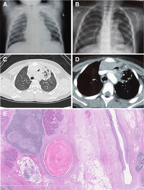 Chest X Ray Lung Ct Showing The Presence Of 1a Left Hilar Enlargement