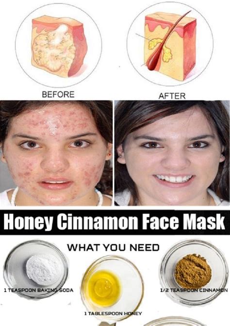 honey and cinnamon face mask for cystic acne 11 anti inflammatory diy