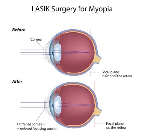 lasik surgery  myopia nearsightedness pediatric ophthalmology pa
