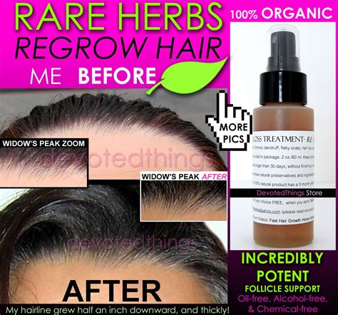 best organic hair regrowth treatment hair loss thinning