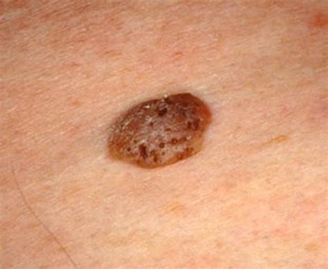 seborrheic keratosis pictures symptoms treatment removal   hubpages