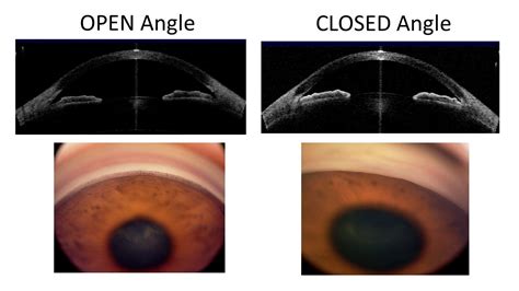 angle closure glaucoma      treatment