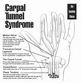 Carpal Cts Surgery Ergonomics Positivemed Wrist sketch template