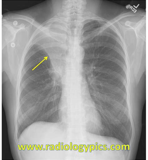 Right Upper Lobe Collapse Frontal Radiograph Of The Chest Reveals A