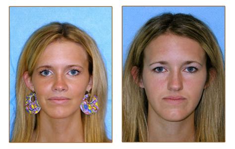 Pictures Orthognathic Jaw Surgery Orlando Pictures Orthognathic Jaw