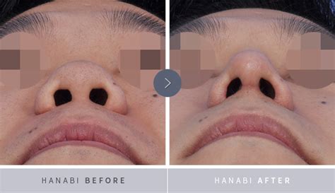 blunt nose hanabi rhinoplasty clinic