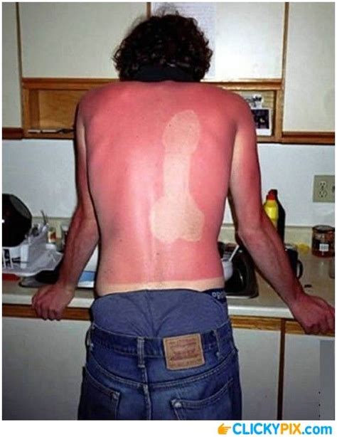 10 Best Bad Sunburns Images On Pinterest Worst Sunburn Funny Photos