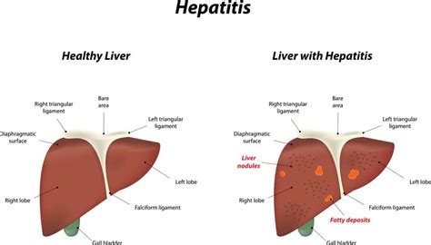 Hepatitis Pathophysiology Podcast And Nursing Care Plan