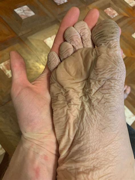 Man Told He Has Trench Foot After Wearing A Pair Of Wet Boots For 10