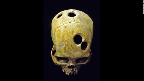Were Mystery Holes In Skulls An Ancient Aspirin Cnn