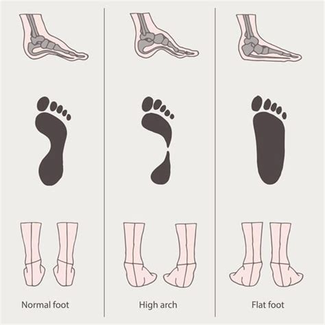 flat feet bruyere foot specialists