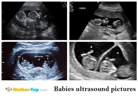 ultrasound gender determination — when and how mother