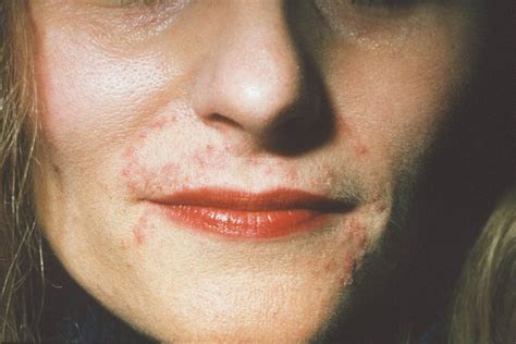 skin conditions    acne  arent  health canada