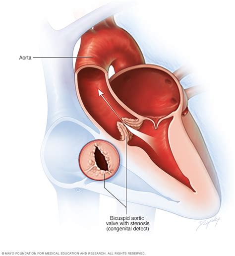 Bicuspid Aortic Valve Overview Mayo Clinic