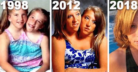 what conjoined twins abby and brittany hensel look like today jesus daily