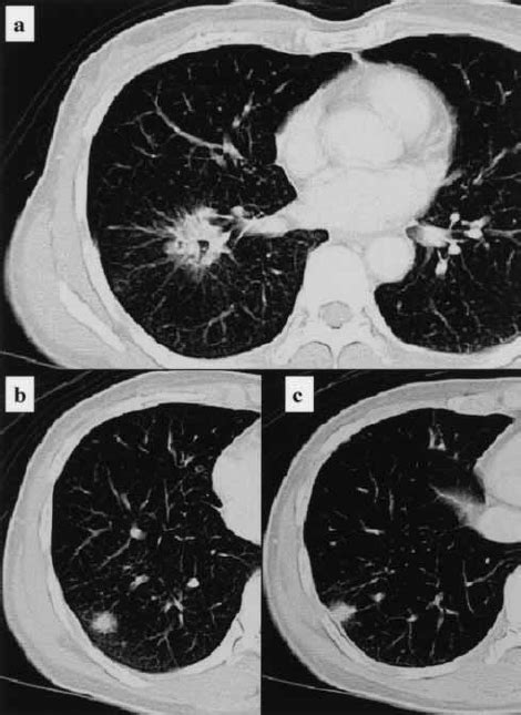Ct Of The Chest Revealed A Hilar Mass Lesion A With Parenchymal