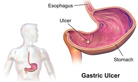 Stomach Ulcer Causes Symptoms And Treatment Healthspresso