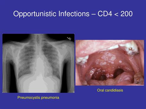 Ppt Hiv Aids And Opportunistic Infections Powerpoint Presentation