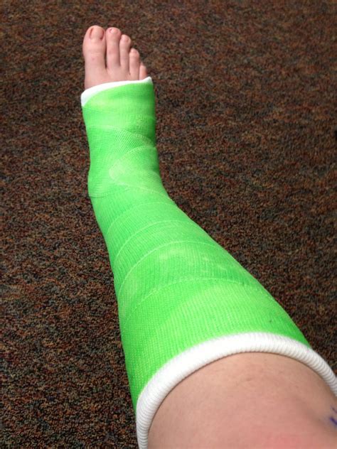 broken ankle  weeks post op  cast