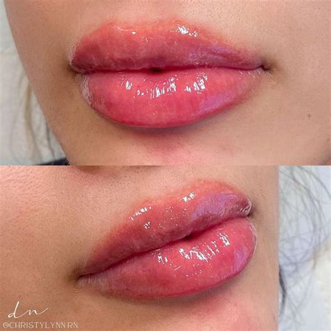 derma noor lips lip fillers lips inspiration full lips makeup