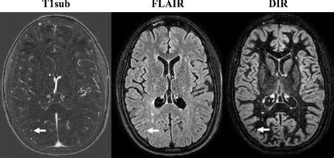 contrast mri  effective  monitoring multiple sclerosis patients