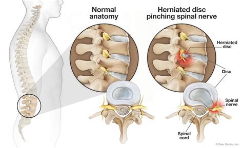 pinched nerve chiropractor  st augustine fl derek sisak dc