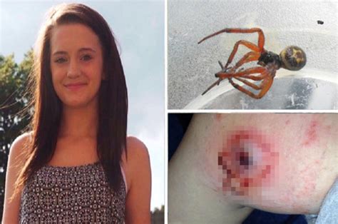 teen s agony after deadly spider bite leaves leg swollen and oozing pus