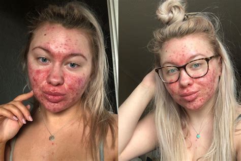 Teenager With Severe Cystic Acne Shares Her Skin Struggles