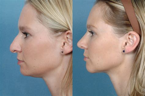nose job   champaign rhinoplasty pictures il