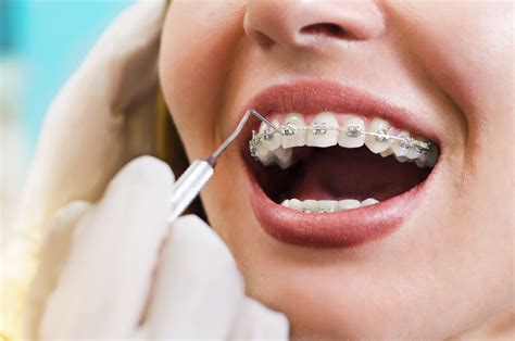 Fixed Braces The London Orthodontic Group