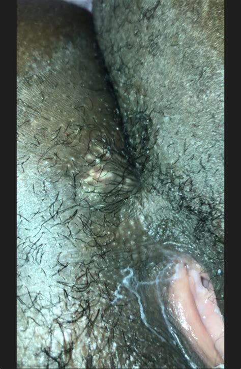 what could this be genital herpes simplex forums patient