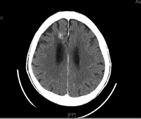 Computed Tomography Scan Of The Brain Prior To Erlotinib Treatment
