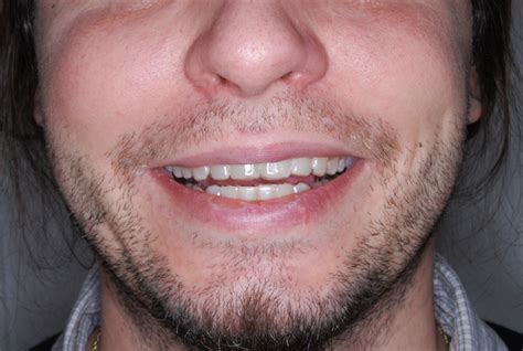 rovnatka invisalign rovnatka prahacz rovnatka ortodoncie  nejlepsi dopravni dostupnosti