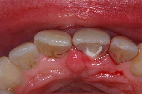 gum disease pictures mouade agafay