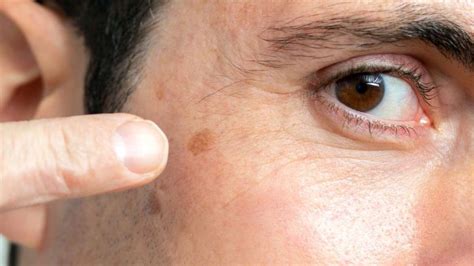 common dark spots   face advanced dermatology   midlands
