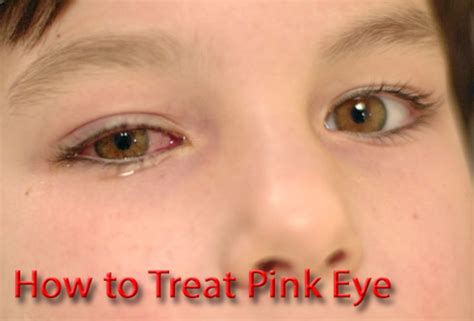treat pink eye   hubpages