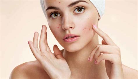cure acne  secrets     rid  acne naturally