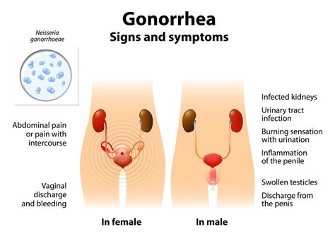 gonorrhea clap symptoms and signs causes treatment