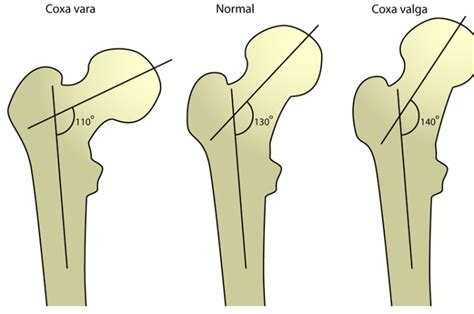 coxa vara   treatment bone  spine