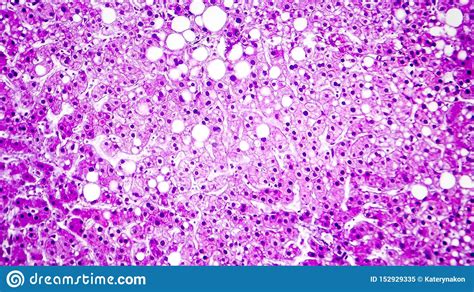 Histopathology Of Liver Steatosis Or Fatty Liver Stock Image Image