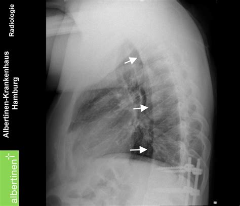 morbus bechterew roe thorax seitl doccheck