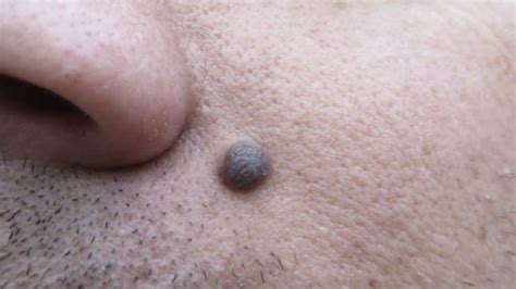 Why Do So Many People Want Their Moles Removed Bbc News