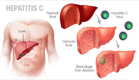 Elevated Liver Enzymes Causes Symptoms And Treatment Tips New Life