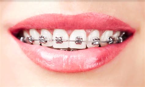 Can Adult Braces Help You To Get A Beautiful Smile Smile Dental
