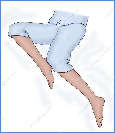 restless leg syndrome illustration stock image c036 6305 science