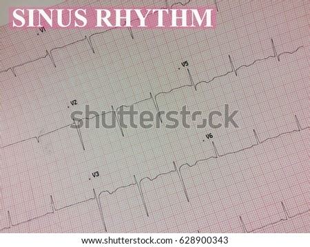 sinus rhythm stock images royalty  images vectors shutterstock
