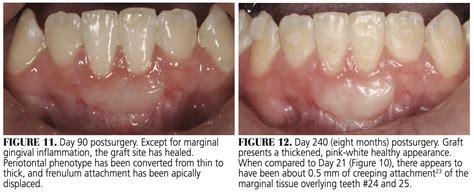 healing progression    gingival graft decisions  dentistry
